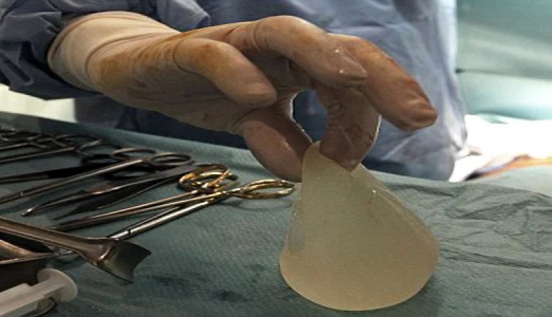 أطباء مكسيكيون يحذرون من استخدام أنسجة ثدي صناعية