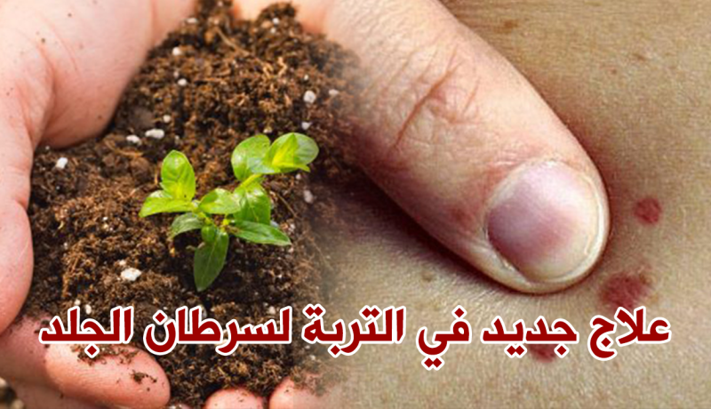 علاج جديد في التّربة يكافح سرطان الجلد