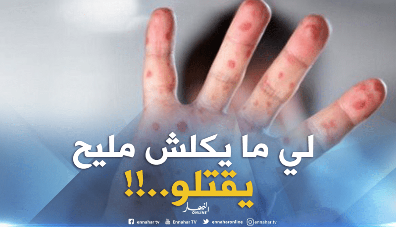 وزارة: “البوحمرون” يقتل الأشخاص الذين يعانون من سوء التغذية