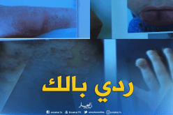 بالفيديو…داء الصدفية مرض يهدد النساء الحوامل