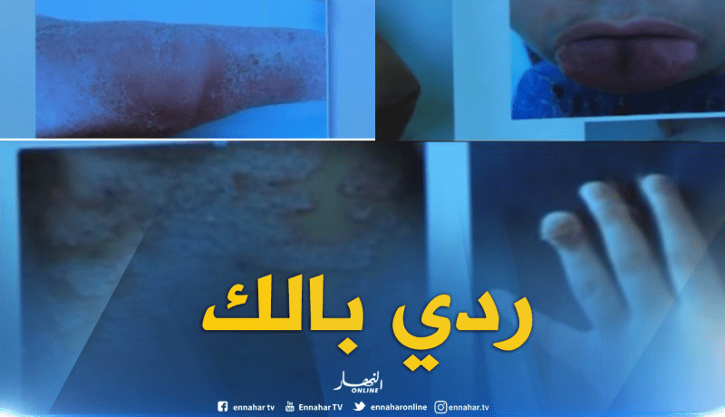 بالفيديو…داء الصدفية مرض يهدد النساء الحوامل