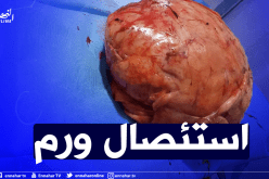 الوادي: طاقم طبي ينجح في استئصال ورم بوزن 40كلغ