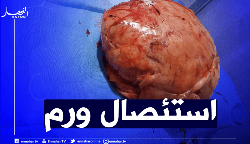 الوادي: طاقم طبي ينجح في استئصال ورم بوزن 40كلغ