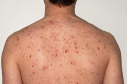تسجيل أول حالة للبحمرون وإشتباه في 10 أخرين بسيدي بلعباس