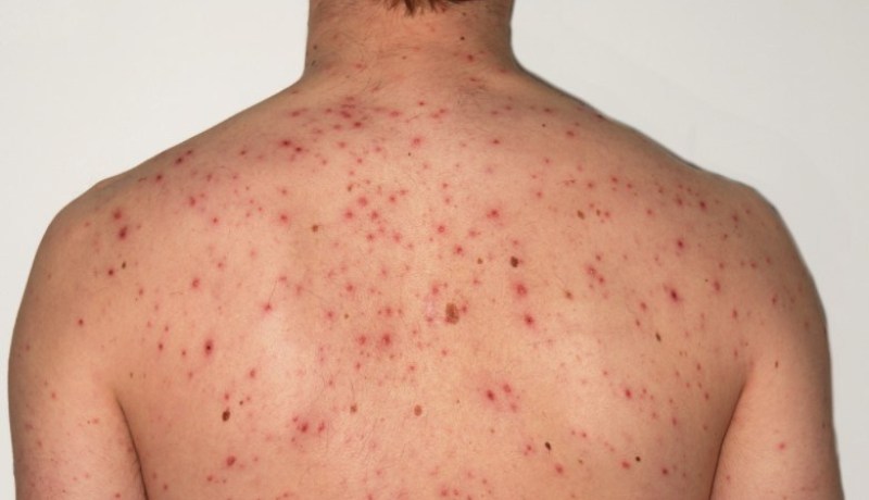 تسجيل أول حالة للبحمرون وإشتباه في 10 أخرين بسيدي بلعباس