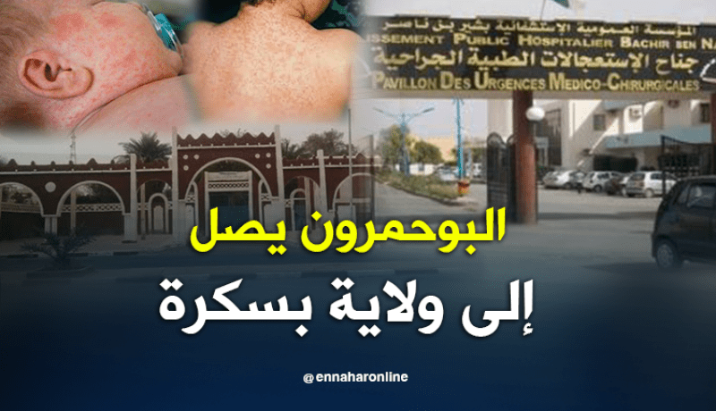 تسجيل 12 حالة لداء البوحمرون ببسكرة