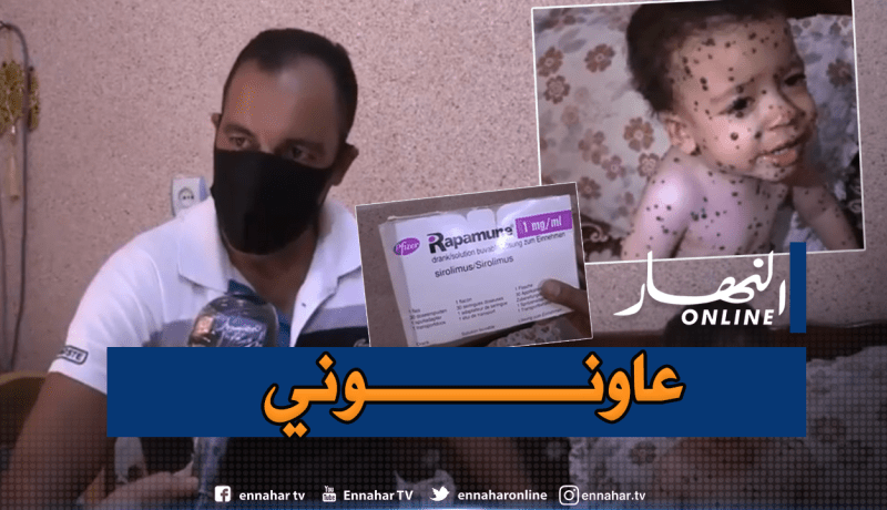 حالته تُبكي الحجر.. الرضيع “أنس” يعاني من مرض نادر ينخر جسده
