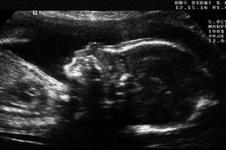 الكشف عن الأمراض قبل الولادة ضمن حدود الأخلاقيات