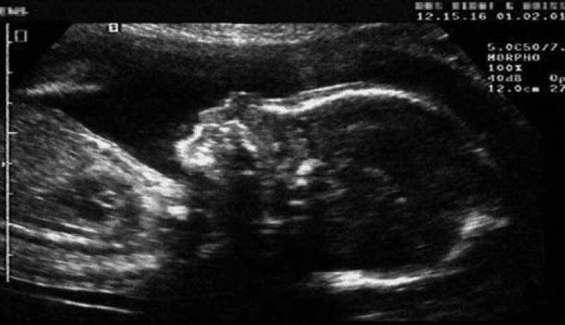 الكشف عن الأمراض قبل الولادة ضمن حدود الأخلاقيات