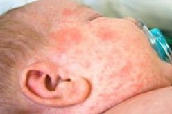 تسجيل 9 حالات بوحمرون مؤكدة وأكثر من 200 حالة مشتبه بها منذ بداية السنة