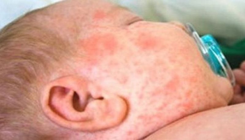 تسجيل 9 حالات بوحمرون مؤكدة وأكثر من 200 حالة مشتبه بها منذ بداية السنة