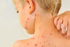 إصابة 8 أطفال بداء “الحصبة” من أصل 64 حالة مشتبه فيها