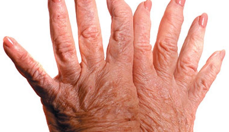 د 3 ملايين شخص يعانون من الالتهاب الروماتويدي بالجزائر