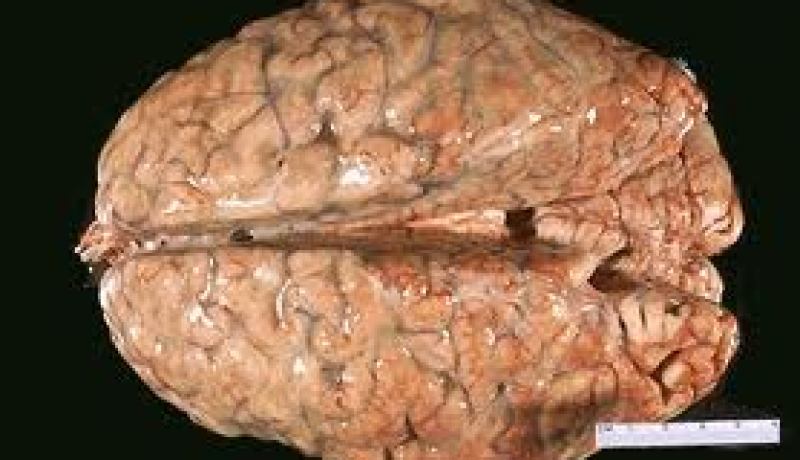 وفاة شخصين بالتهاب السحايا بعين الملح بالمسيلة