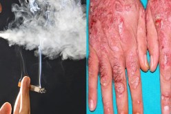 التدخين يزيد من مخاطر الإصابة بداء الصدفية