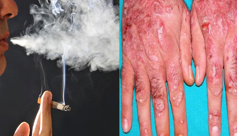 التدخين يزيد من مخاطر الإصابة بداء الصدفية