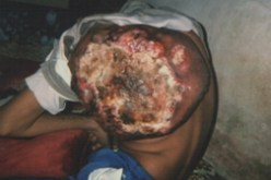 الشاب اسماعيل نقراش يناشد رئيس الجمهورية معالجته في الخارج لإنقاذ حياته