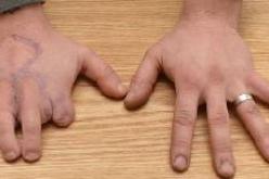 يستبدل أصابع يديه بأصابع قدميه!!