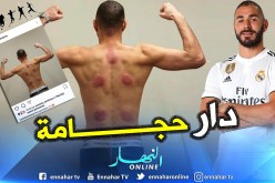 “بن زيمة” يسترجع بإستعمال “الحجامة” !!