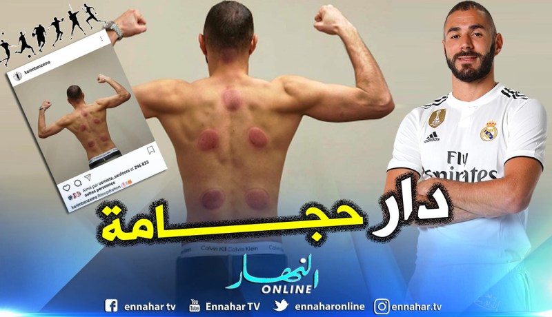 “بن زيمة” يسترجع بإستعمال “الحجامة” !!
