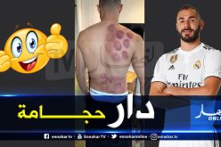 بن زيمة يستنجد بالحجامة