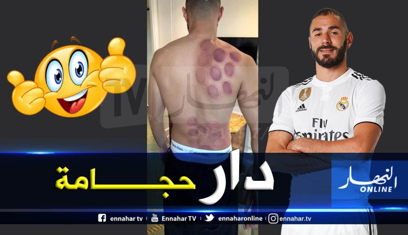 بن زيمة يستنجد بالحجامة