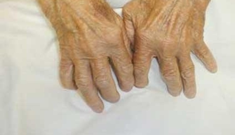 الجينات الوراثية قد تتسبب في نقص فيتامين “د” في الجسم