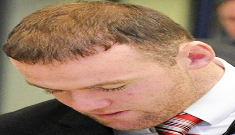 روني‮ ‬يزرع شعرا بـ‮03 ‬ألف جنيه استرليني