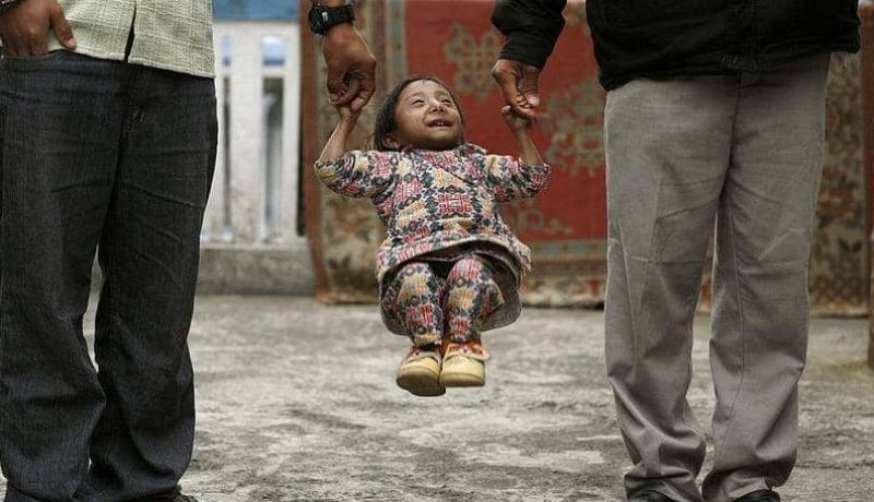 وفاة أقصر رجل في العالم عن عمر ناهز 27 عاماً