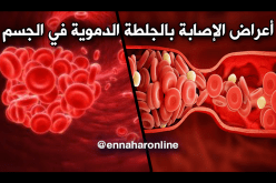 ما الذي يجب أن تعرفه عن الجلطة الدموية وأعراضها!!
