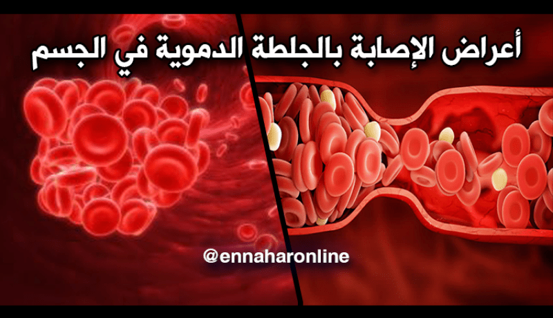 ما الذي يجب أن تعرفه عن الجلطة الدموية وأعراضها!!