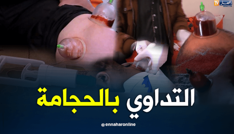 الحجامة.. علاج متداول رغم تطور الطب