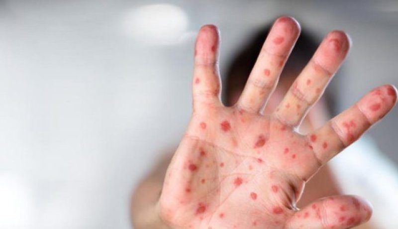 تسجيل 24 حالة يشتبه إصابتها “بالبوحمرون” في عنابة
