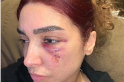 6 غرز في وجه روجينا بعد اصابتها أثناء التصوير