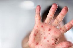 وزارة الصحة تحصي أكثر من 10 آلاف إصابة بالبوحمرون منذ جانفي 2019