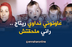 ريتاج تعيش بنصف جمجمة بحاجة لإجراء عملية في الخارج