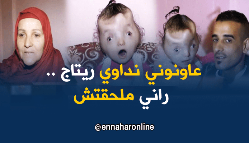 ريتاج تعيش بنصف جمجمة بحاجة لإجراء عملية في الخارج