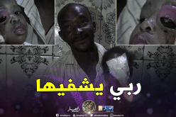 غرداية.. مرض غريب يصيب عين الطفلة حميدة ويتسبب في تشويه وجهها بالمنيعة