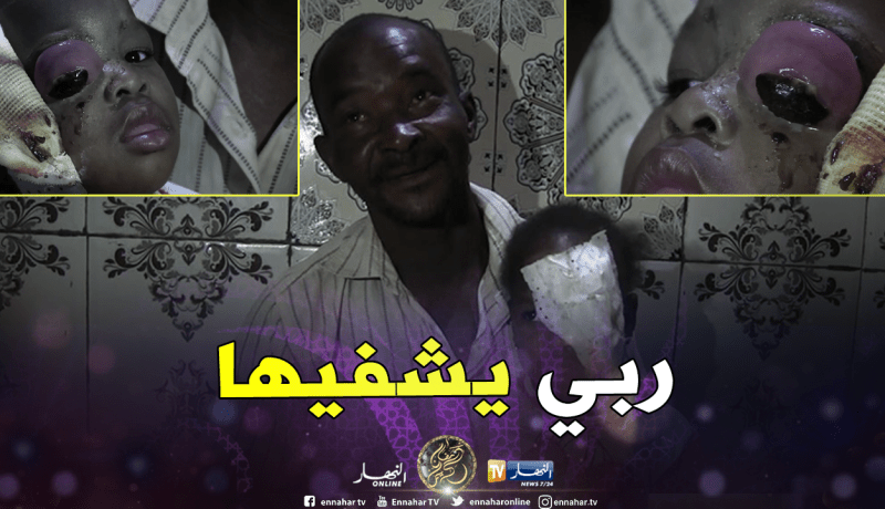 غرداية.. مرض غريب يصيب عين الطفلة حميدة ويتسبب في تشويه وجهها بالمنيعة