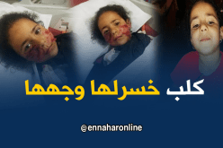 بالصور…كلب يشوّه وجه الطفلة أسماء بسيدي بلعباس