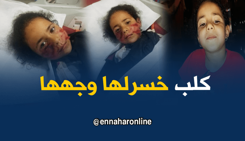 بالصور…كلب يشوّه وجه الطفلة أسماء بسيدي بلعباس