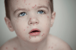 إنخفاض وفيات ” الحصبة ” في العالم