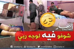 طفل معوز مصاب بمرض الفيل يحرم من منحة 3 الاف دينار بوهران
