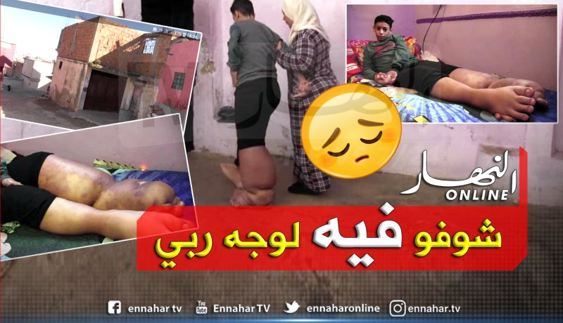 طفل معوز مصاب بمرض الفيل يحرم من منحة 3 الاف دينار بوهران
