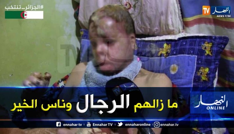 جيلالي مهري يتكفل بعلاج شاب ونفقات عائلته بعدما تحولت حياته إلى جحيم بسبب حروق في الجسد والوجه