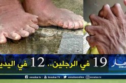 حالة نادرة.. سيدة هندية تعاني من كثرة الأصابع والجيران