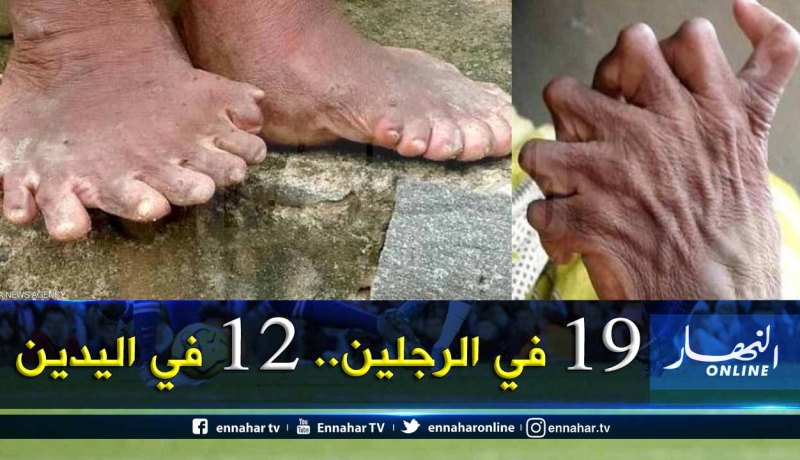 حالة نادرة.. سيدة هندية تعاني من كثرة الأصابع والجيران