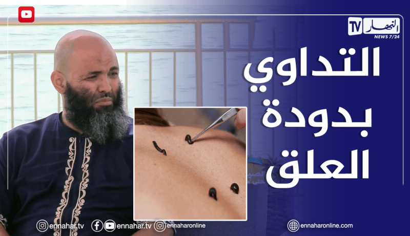 الصيف يحلى معنا / فوائد التداوي بدودة العلق