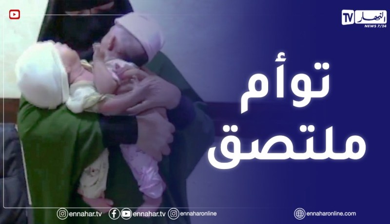عائلة خرخار تستنجد السلطات لعلاج التوأم الملتصق في البطن