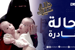 دلال خير: توأم بجسد واحد في حالة نادرة الحدوث وأمهم تناشد المحسنين وذوي الإختصاص للنظر في حالتهم